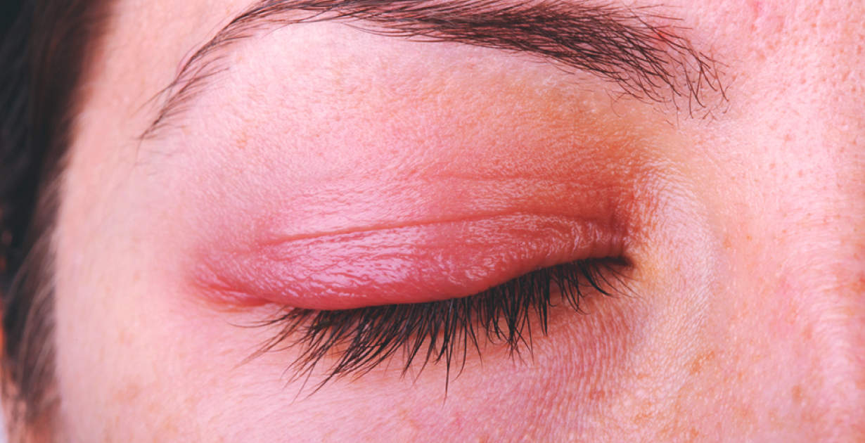 Blepharitis 7 natürliche Behandlungen zur Linderung eines entzündeten Augenlids