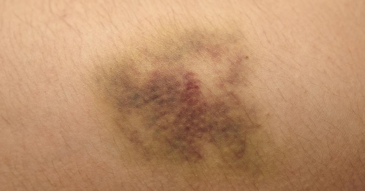 Blutergüsse - Symptome, Ursachen, Behandlungen - Dr.med.Julia.com