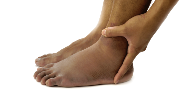 Ödeme: Was es ist, mögliche Ursachen, Symptome und Behandlungen - Dr.med.Julia.com