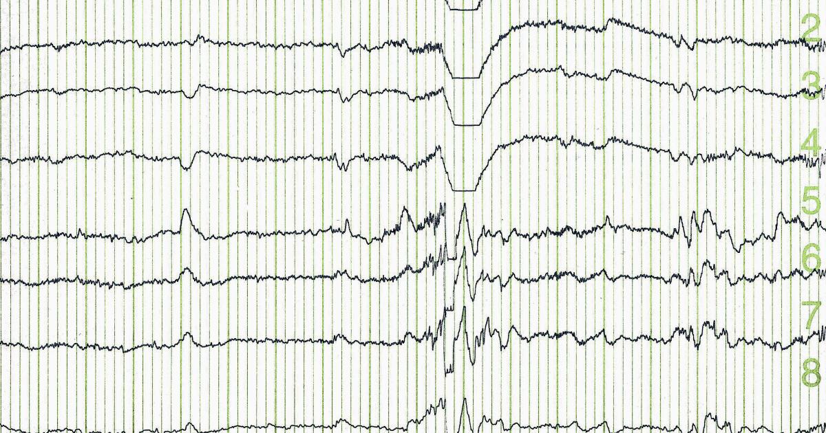 Was Sollte Man Vor Einem Eeg Nicht Machen drmedjulia.com