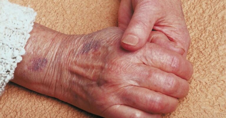 Handkrämpfe: Symptome, Ursachen, Behandlungen & Komplikationen - Dr.med